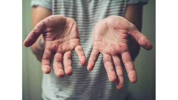 Increase in Disease Incidence in South Africa